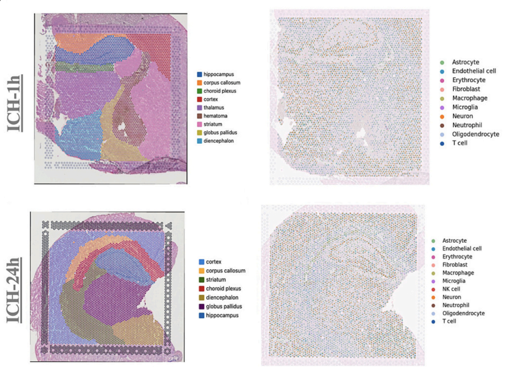 Endothelial pyroptosis-driven microglial activation in choroid plexus mediates neuronal apoptosis in hemorrhagic stroke rats